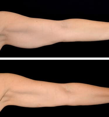 One treatment of CoolSculpting for the arms