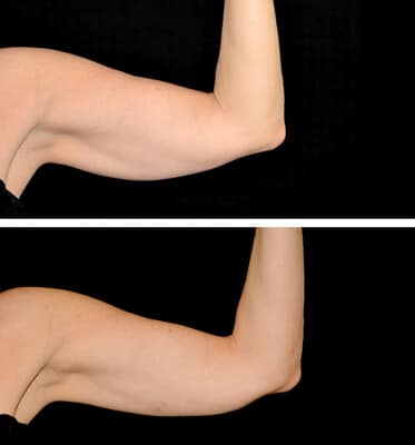 One treatment of CoolSculpting for the arms
