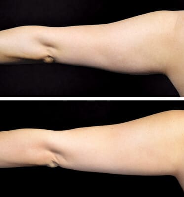 One CoolSculpting treatment for the arms