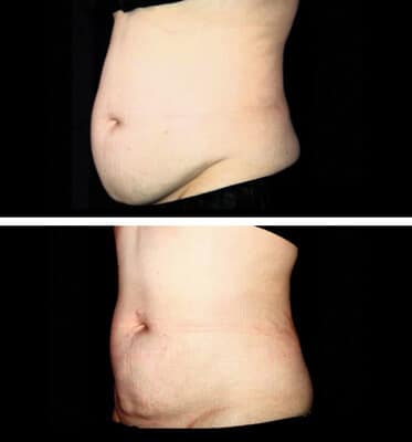 One CoolSculpting treatment for the abdomen areas