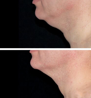 One treatment of CoolMini for the chin