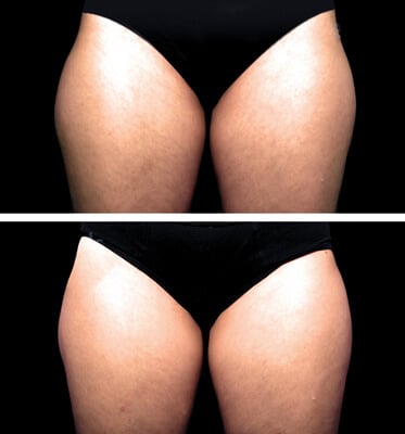 One treatment of CoolSculpting for outer thighs