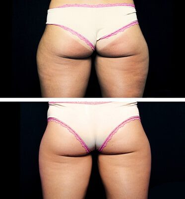 Two treatments of CoolSculpting for outer thighs