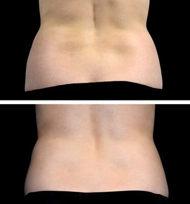 One treatment of CoolSculpting for the love handles