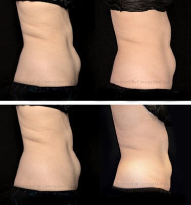 After two treatments of Coolsculpting for lower abdomen