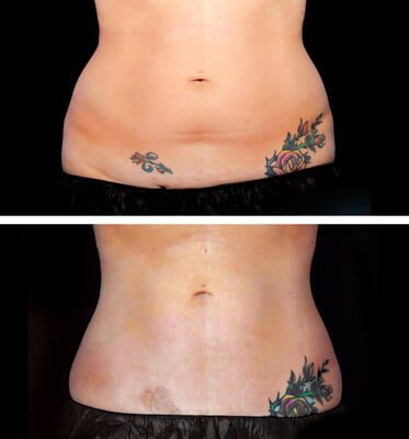 CoolSculpting Stomach Skin Tightening Procedures in Beverly Hills