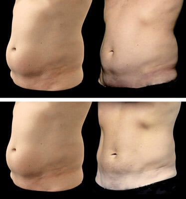 After two treatments of CoolSculpting for the abdomen and love handles