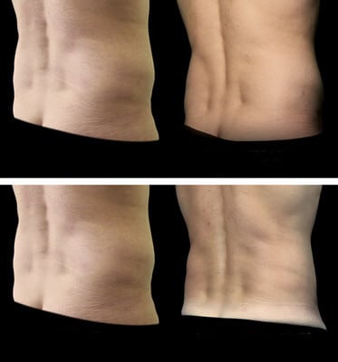 After two treatments CoolSculpting for the love handles