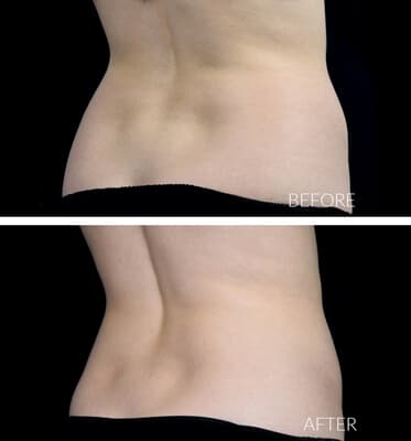 One CoolSculpting treatment for the love handles