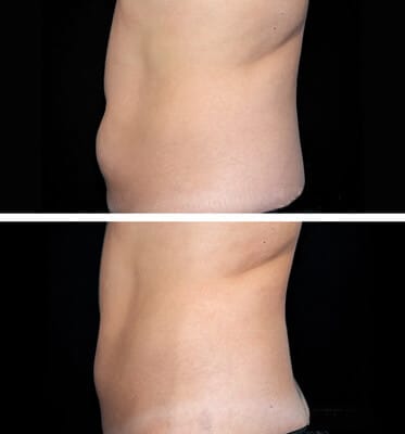 One treatment CoolSculpting for lower abdomen