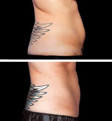 One treatment CoolSculpting for abs and love handles