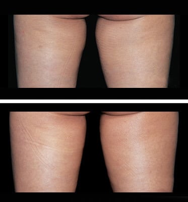 One treatment of CoolSculpting for inner thighs
