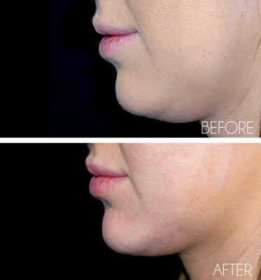 Chin Fillers