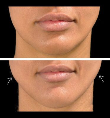 Jaw Fillers