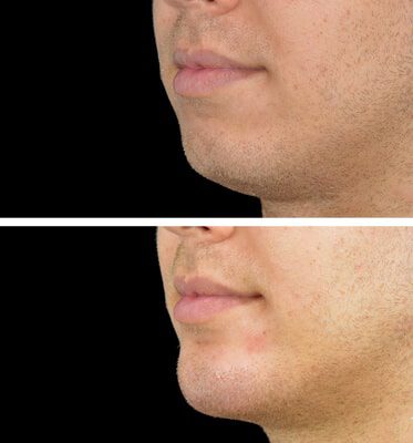 Chin & Jaw Fillers