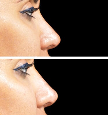 Nose Fillers