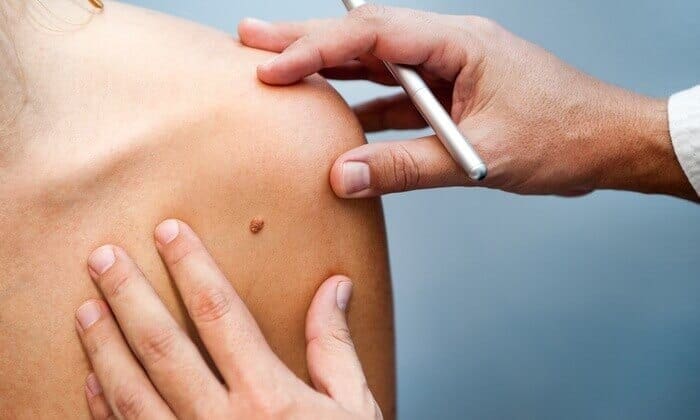 Skin Tag Removal