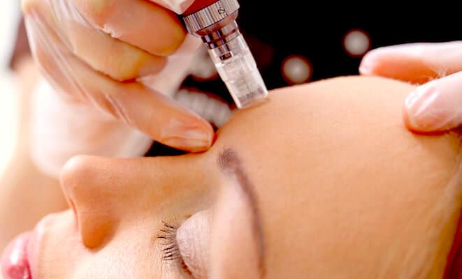 Microneedling with PRP