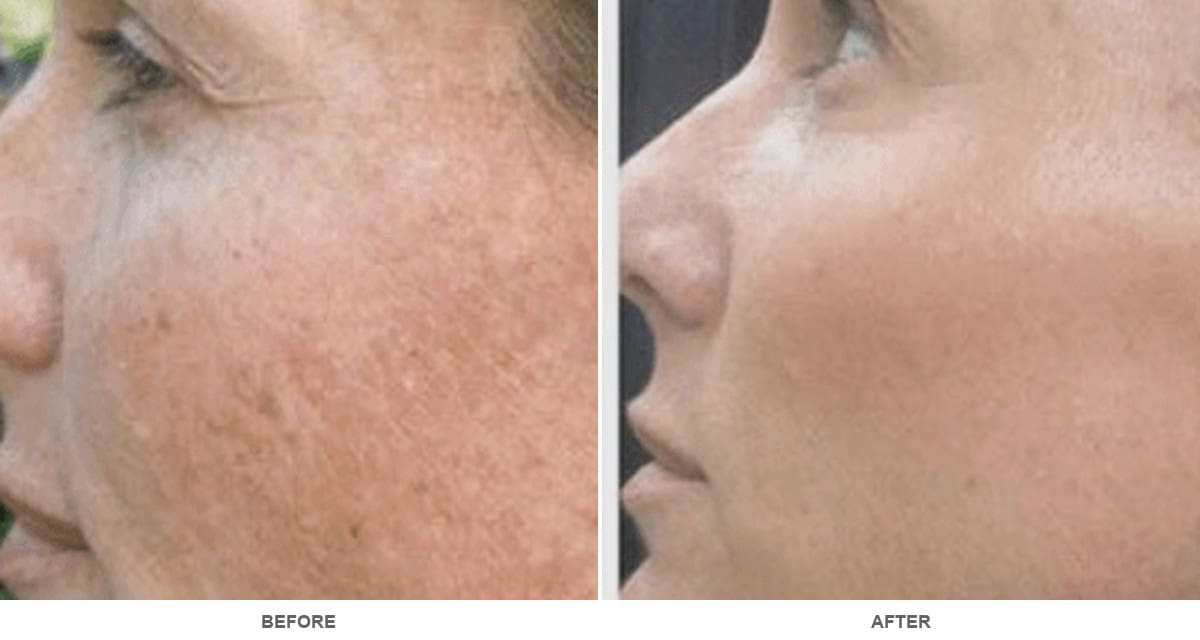 VI Peel before and after showing melasma and skin discoloration improvement in profile view